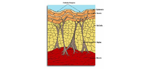 Cellulite